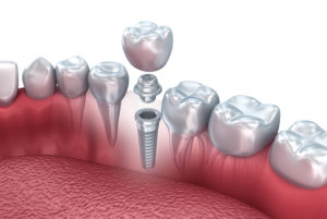 implantacija_zubov3